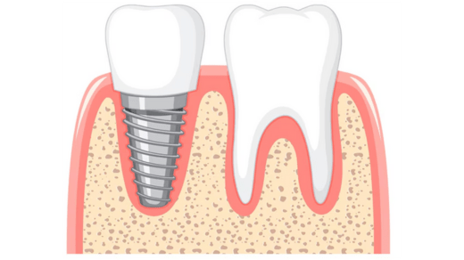 Prevention and Early Treatment of Tooth Pain